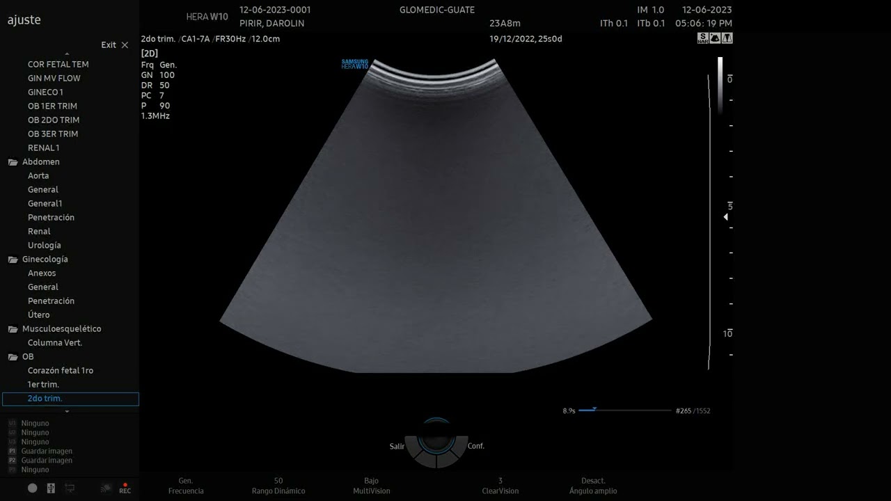 ECO OBSTET 1 con el Hera w10 Elite de Samsung.