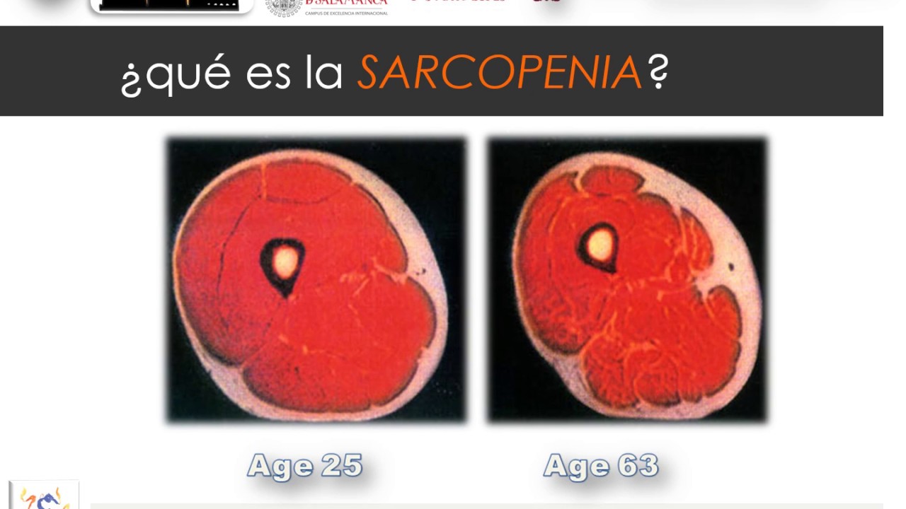 Mejora de la sarcopenia mediante Ejercicio Terapéutico de Fuerza en Personas de Edad Avanzada