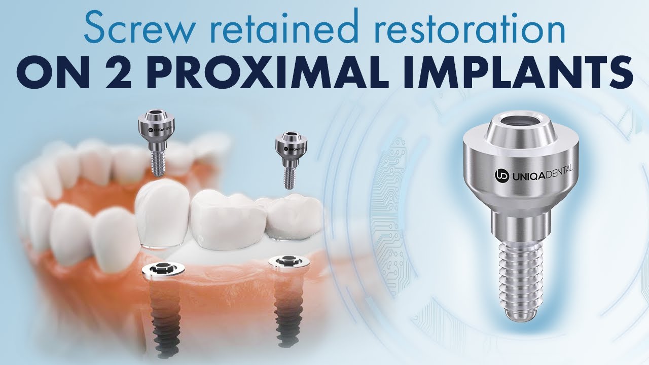 Screw retained restoration on 2 proximal implants. The scan abutments we used & all the multi units