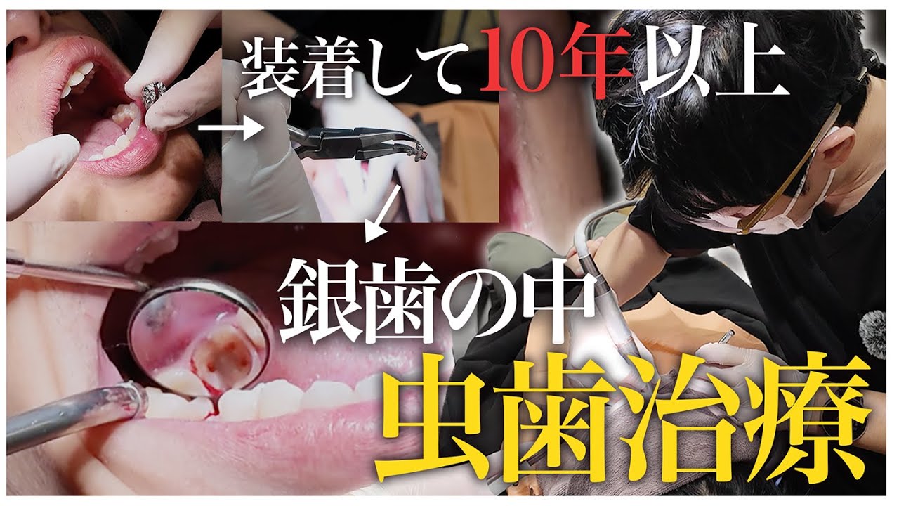 装着して10年以上！銀歯の中の虫歯を治療【名古屋みなみ歯科・矯正歯科】