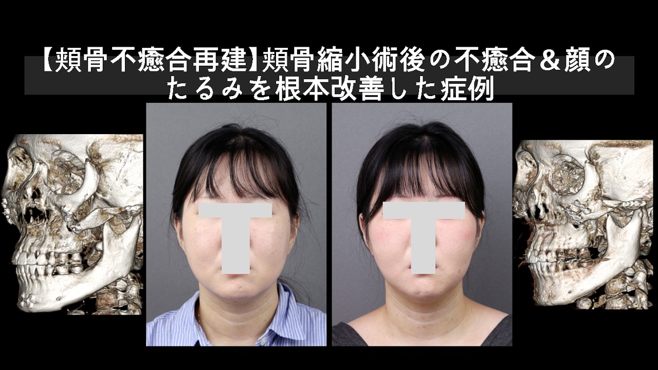 【頬骨不癒合再建】頬骨縮小術後の不癒合＆顔のたるみを根本改善した症例
