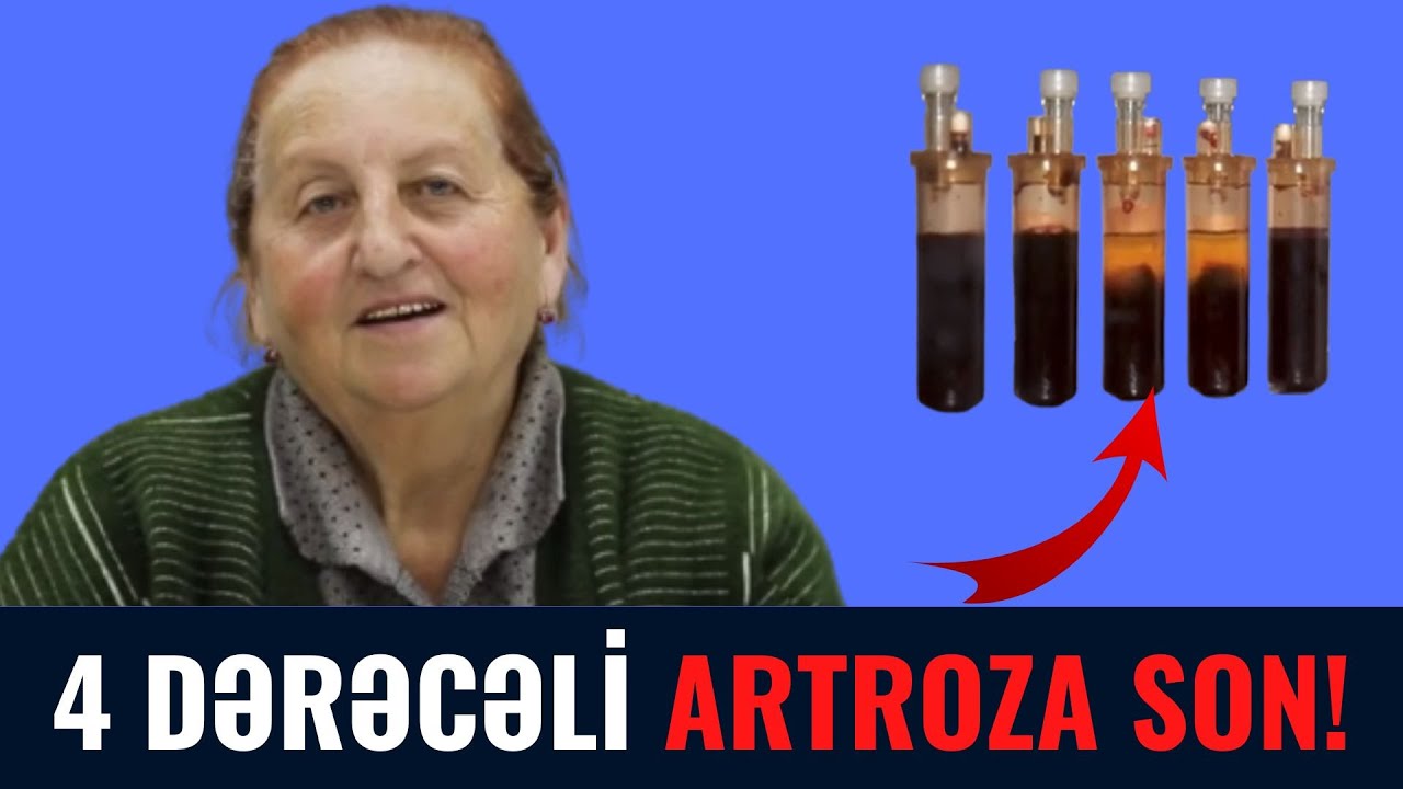 Dördüncü Dərəcəli Artroza SON! - Pasiyent Sevinci...