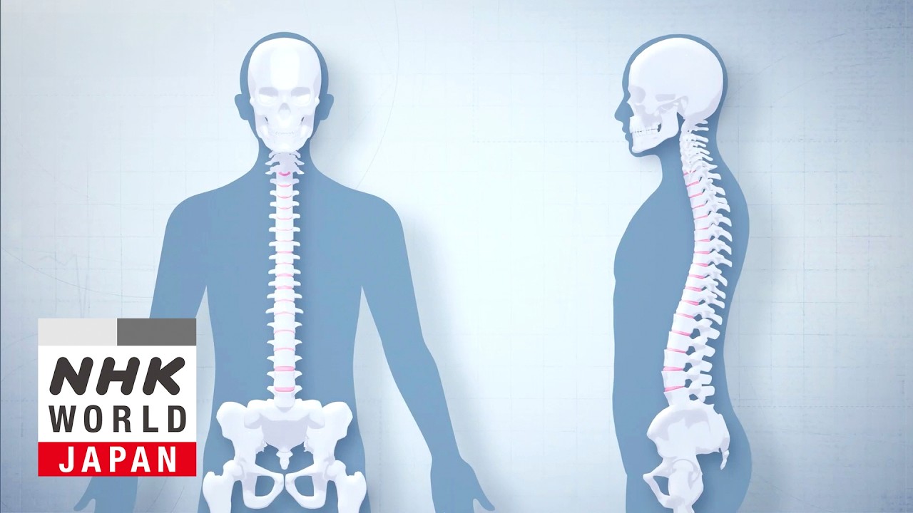 Straightening a Bent Spine Through Exercise - Medical Frontiers