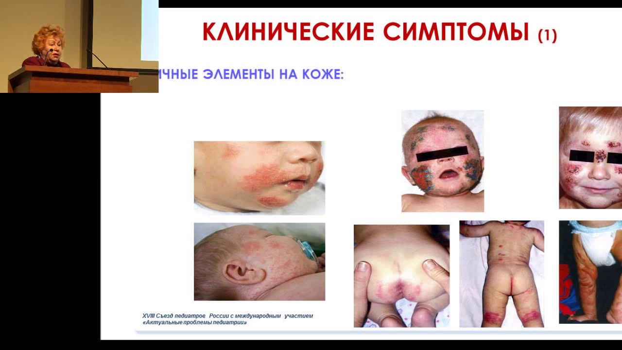 17.02.2017 - Первые проявления пищевой аллергии у детей раннего возраста. На приеме у педиатра.