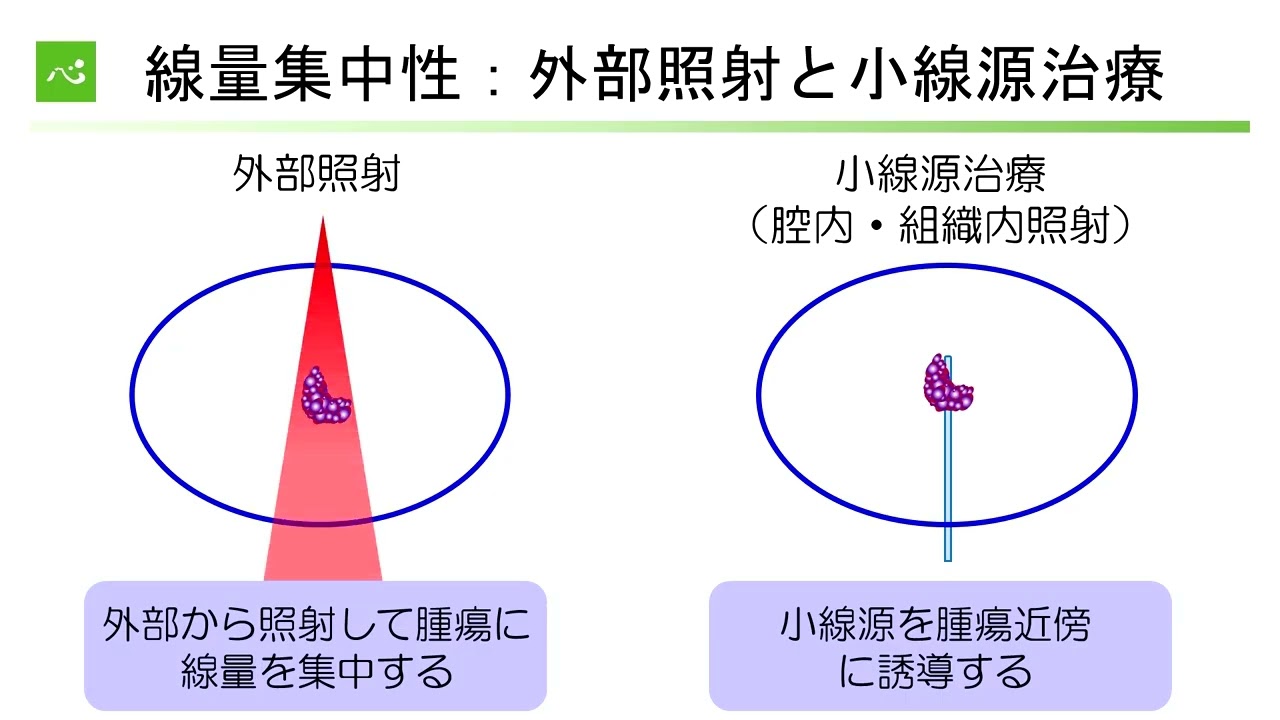 がんの放射線治療～現在の到達点～（放射線・陽子線治療センター小線源治療科　朝倉浩文）【静岡がんセンター公開講座2025】