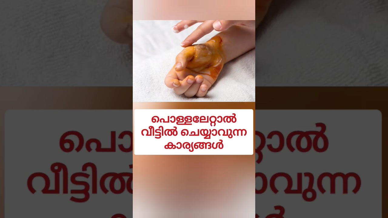 ചെറിയ പൊള്ളലേറ്റാൽ ആദ്യം വീട്ടിൽ ചെയ്യേണ്ട കാര്യങ്ങൾ #skinburn ##shorts #remedies #ashortaday