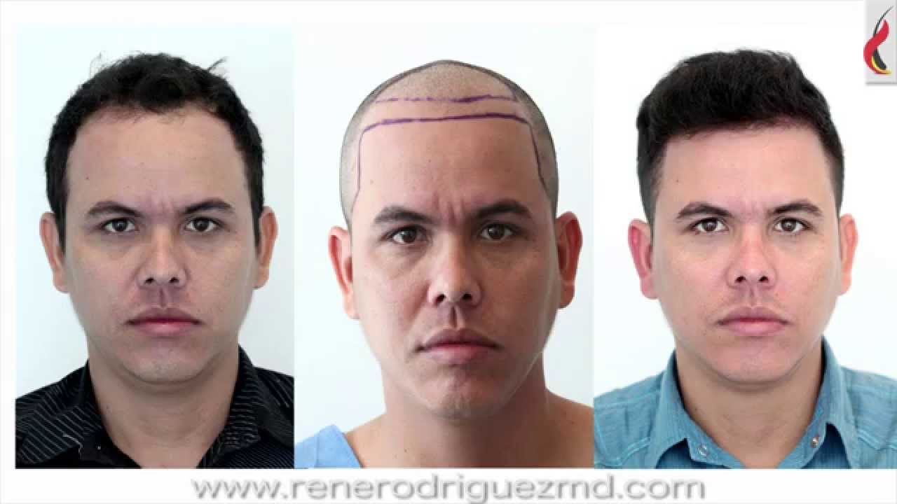 4000 follicular units, FUE method 2RMD, one session
