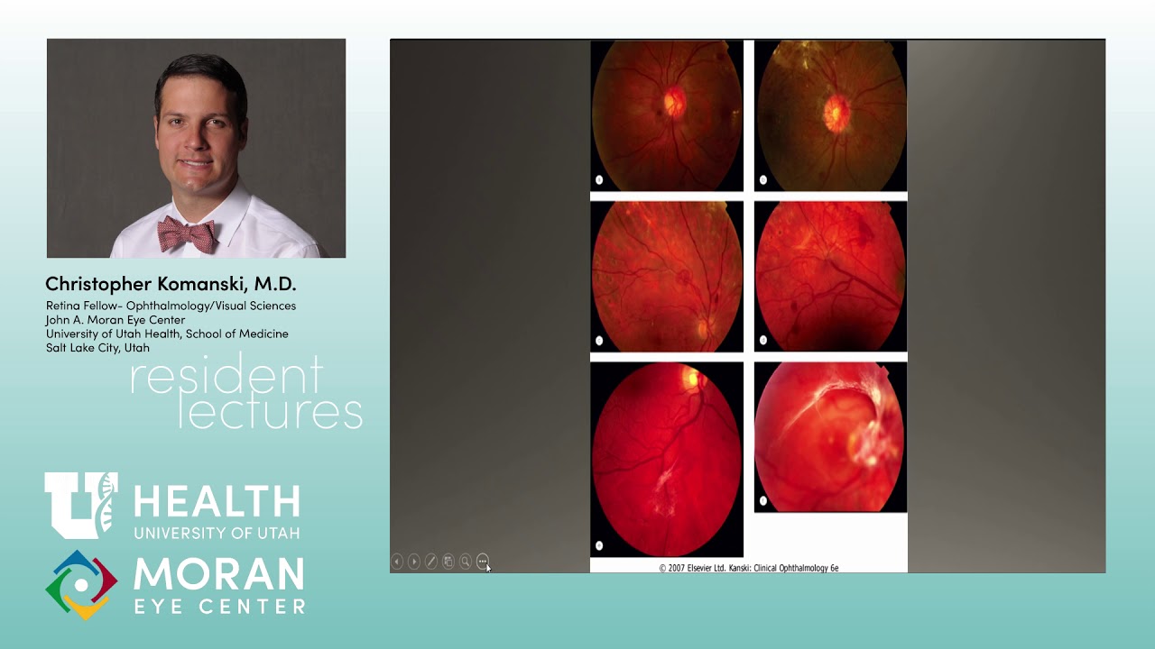 Diabetic Retinopathy