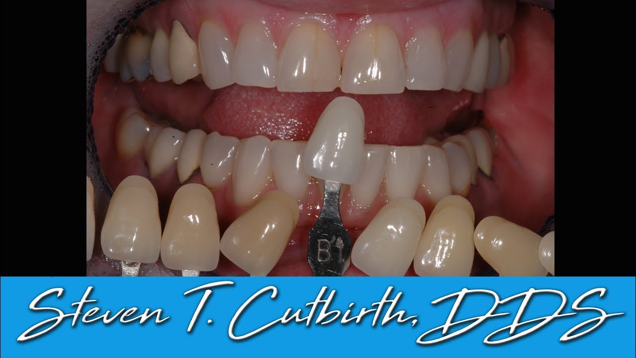Shade Matching Veneers - Dental Minute with Steven T. Cutbirth, DDS