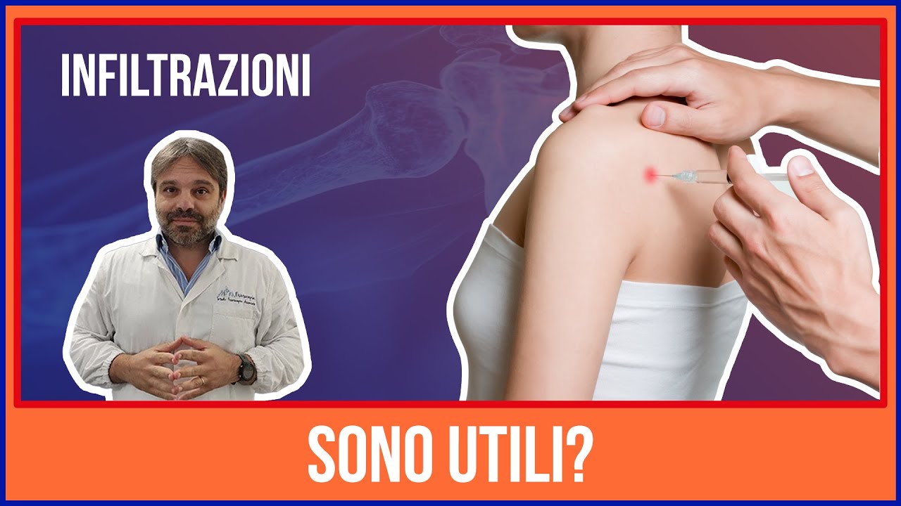 Scopri se le INFILTRAZIONI alla SPALLA per lesione del SOVRASPINOSO sono UTILI