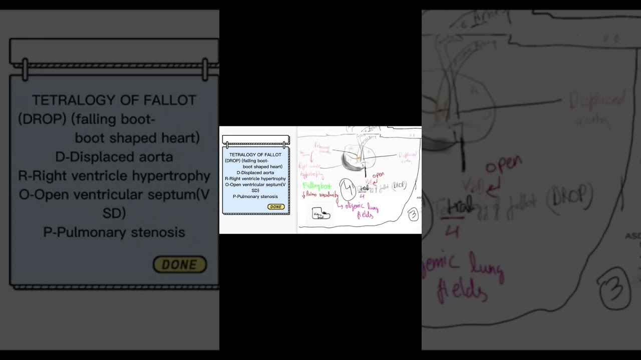 Cyanotic heart diseases in 1 minute #shorts #plab1 #usmlesteps #paediatric #mbbs #mbbsnotes
