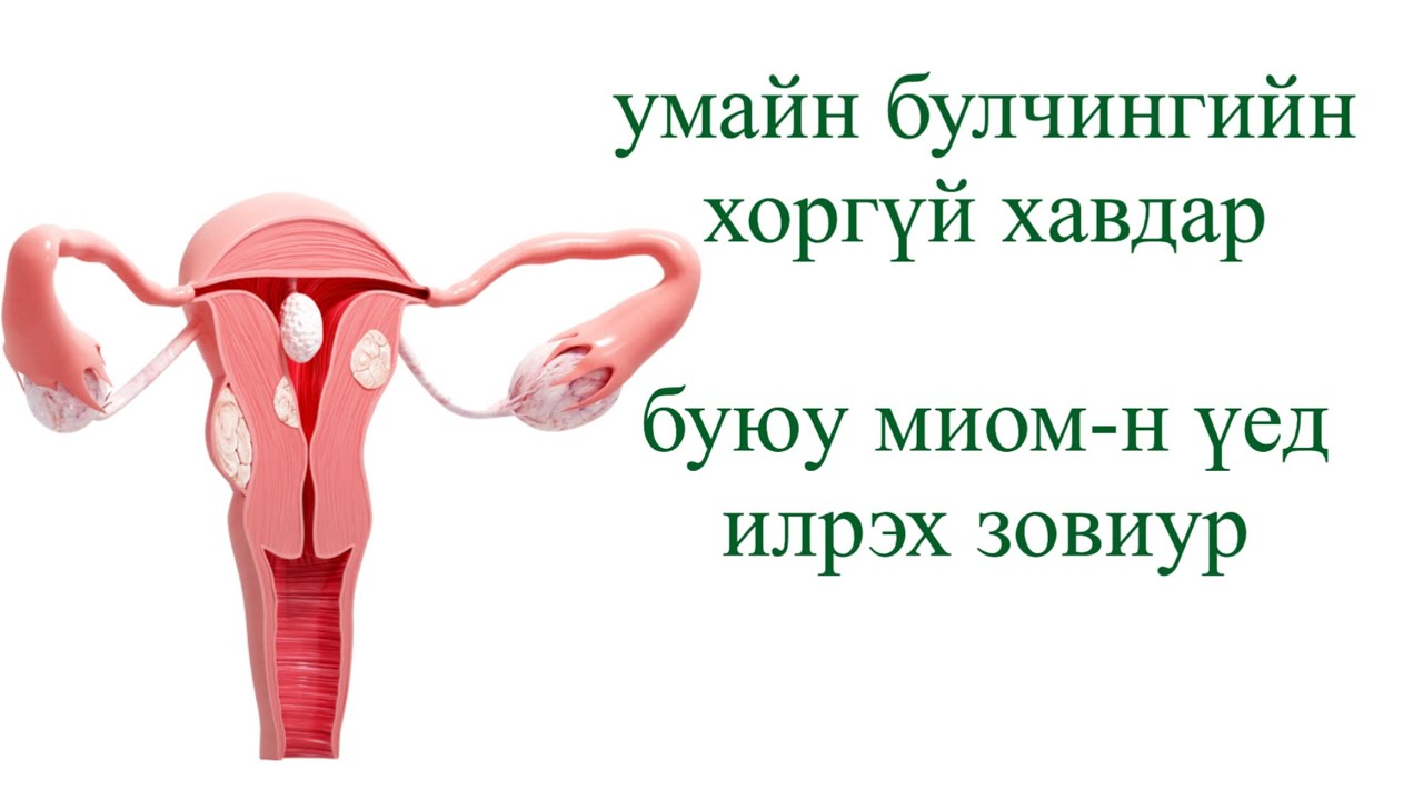 умайн булчингийн хоргүй хавдар буюу миом болон киста 2-н ялгаа