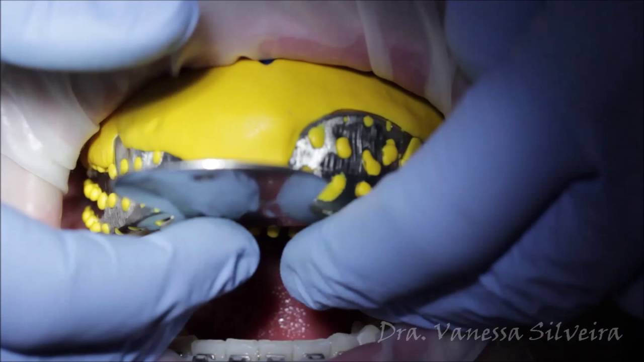 Preparo dos Dentes + Moldagem + Mockup