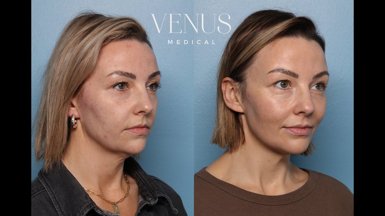 Total Facial Rejuvenation at Venus Medical