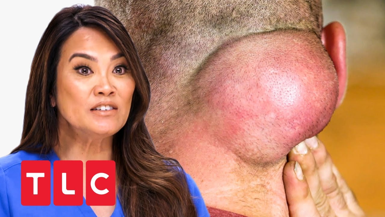 Ein Tumor im Nacken! | Dr. Pimple Popper | TLC Deutschland
