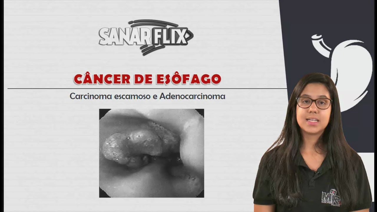 Câncer de Esôfago - Carcinoma escamoso e Adenocarcinoma - Aula SanarFlix