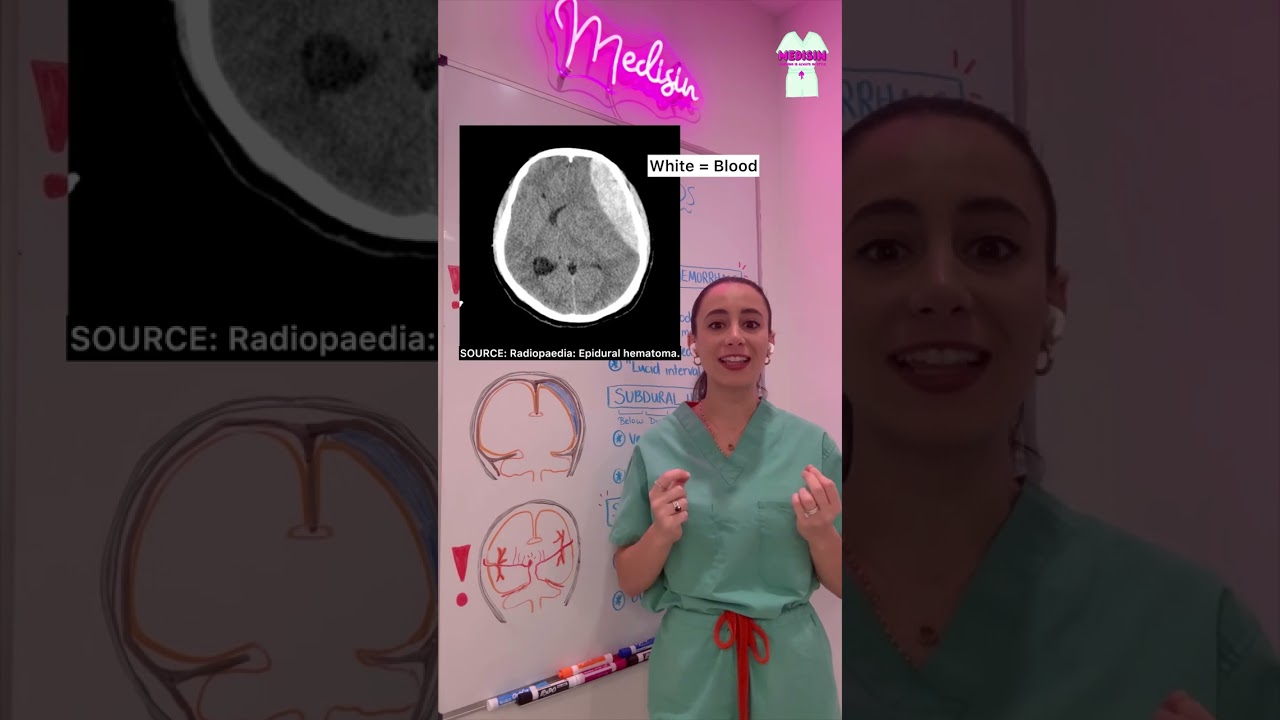 Medisin - Brain Bleeds / Cerebra Hemorrhages - Epidural, Subdural, Subarachnoid hemorrhages