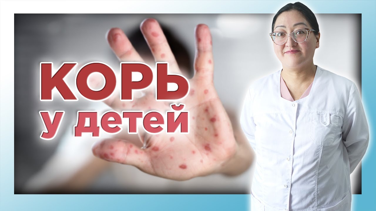КОРЬ | Вакцинация. Симптомы. Диагностика. Лечение