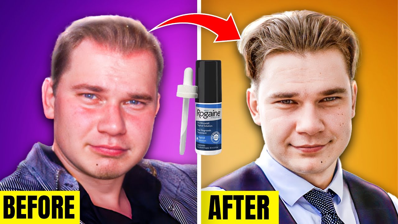 Обзор 10-летнего применения препарата Rogaine (миноксидил) — ОН РАБОТАЕТ!!