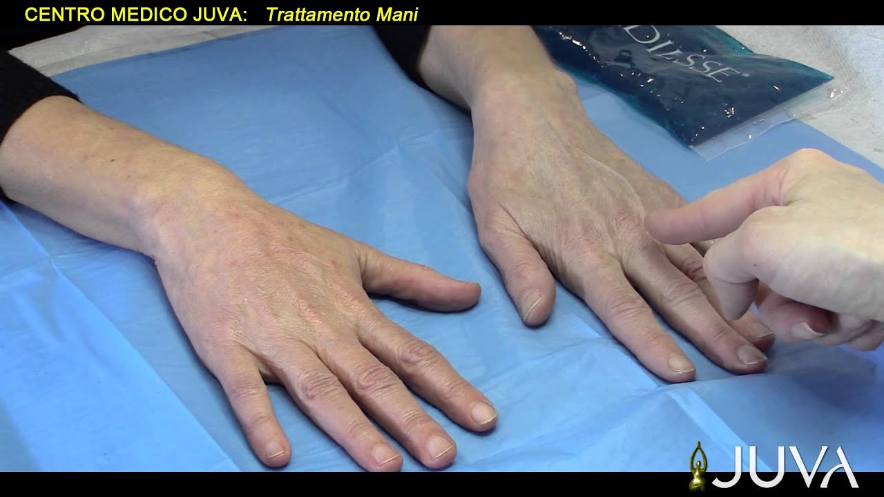 Juva   Trattamento Mani con Radiesse