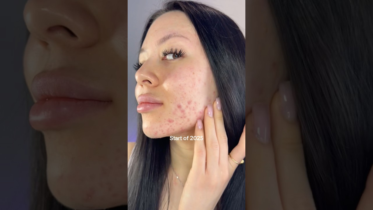 But my acne journey starts in 2015..