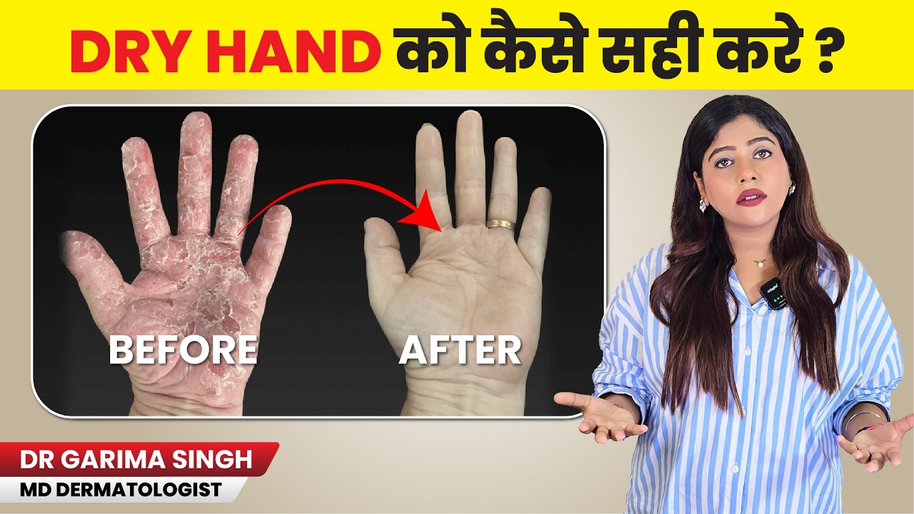 क्या आपके हाथ बार-बार ड्राई हो रहे हैं? Winter Dryness Ya Hand Dermatitis | Symptoms & Care in Hindi