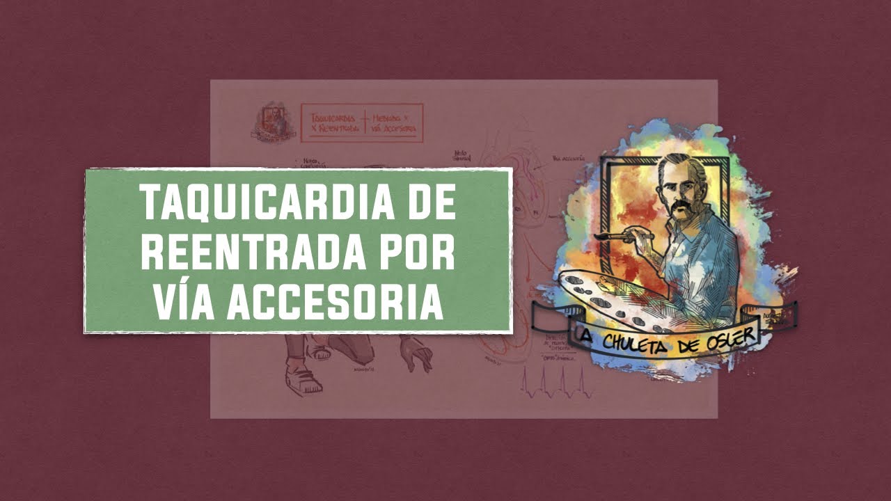 Taquicardia con reentrada por vía accesoria - Ultrarrepaso