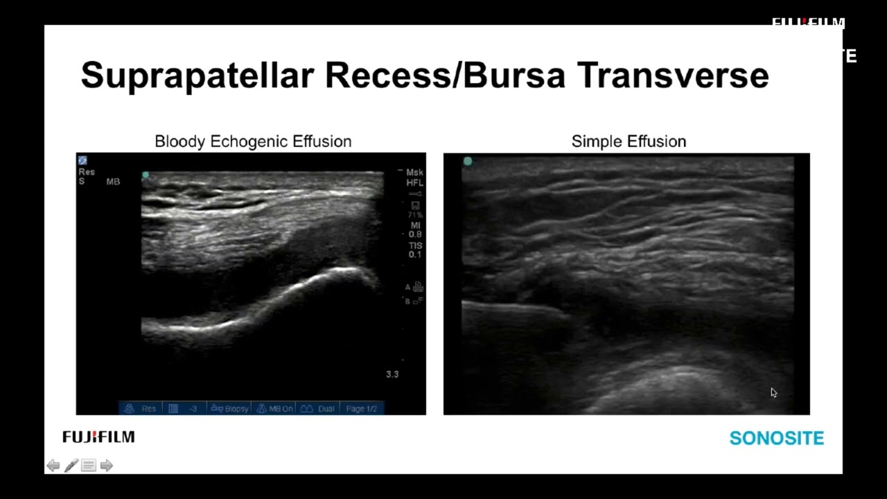 Webinar: Ultrasound Evaluation of the Anterior Knee