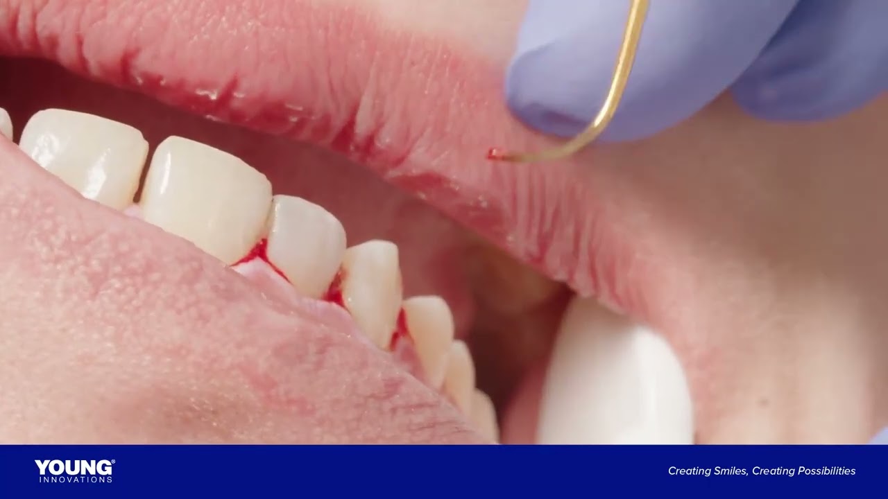 Introducing PerioDT&reg; with Desiccation Technology