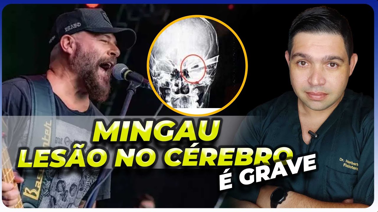 MINGAU BAIXISTA DO ULTRAJE A RIGOR: O PROJÉTIL ATRAVESSOU O CÉREBRO e PROVAVEIS SEQUELAS