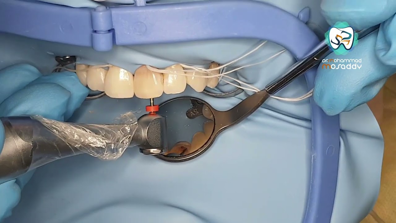 اعادة معالجة للأقنية لثنية علوية    re- treatment  for upper central