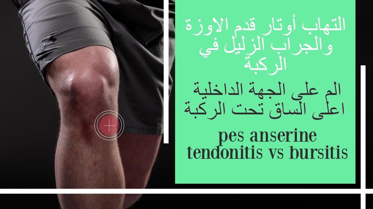 الم على الجهة الداخلية اعلى الساق تحت الركبة  -  التهاب أوتار قدم الاوزة والجراب الزليل في الركبة
