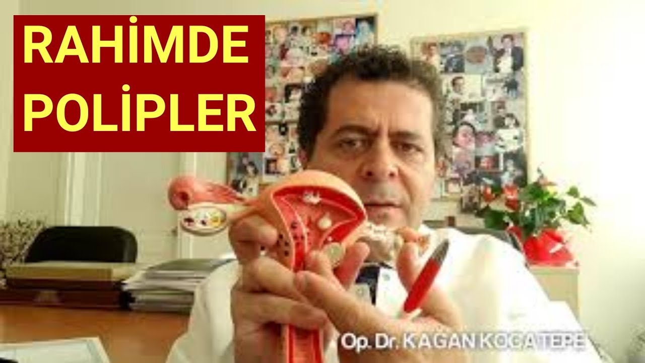 RAHİMDE POLİP NEDİR, NASIL TANI KONUR, NASIL TEDAVİ EDİLİR,NE ŞİKAYETE YOL AÇAR,AMELİYAT GEREKİR Mİ?