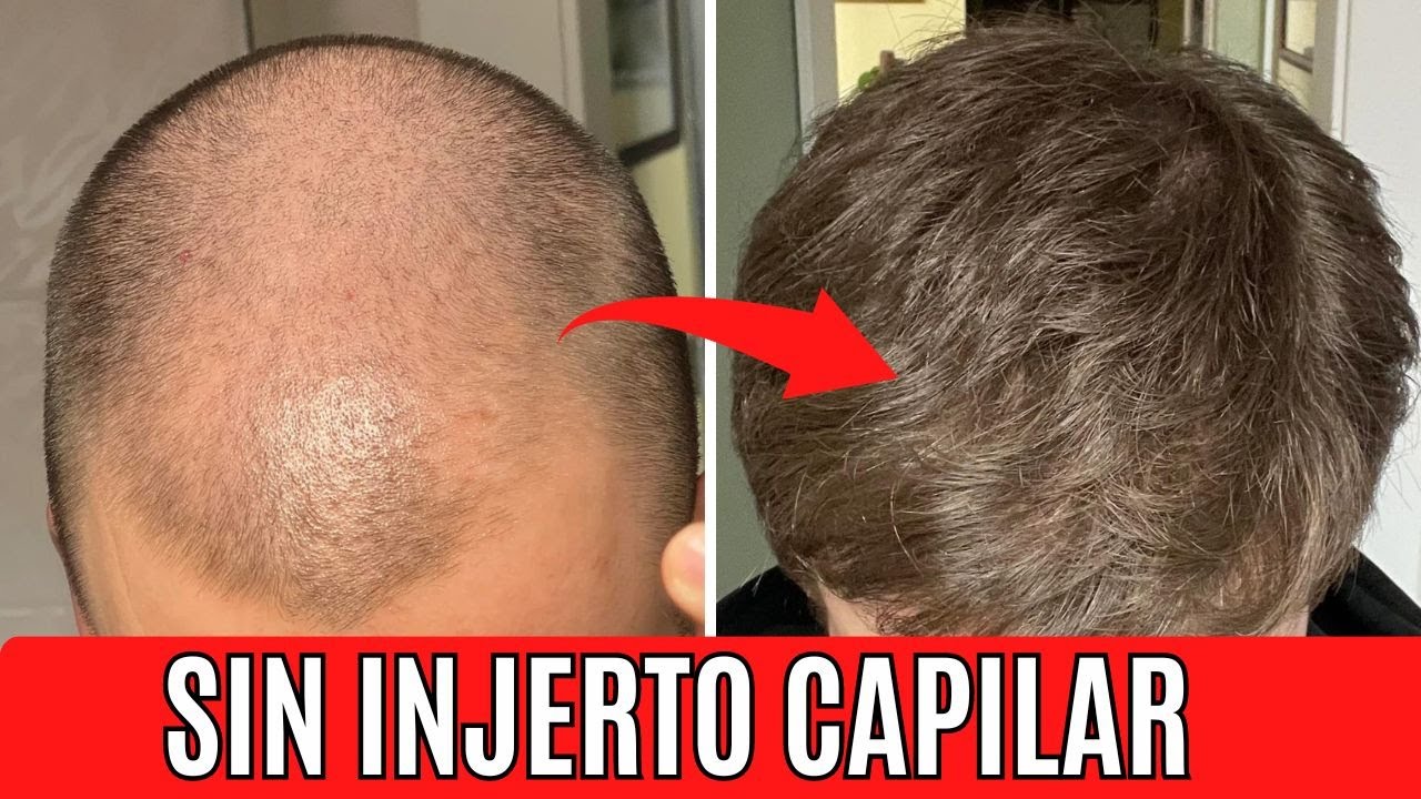Descubre como recuperó el pelo SIN INJERTO CAPILAR 😮 EVOLUCIÓN CAPILAR