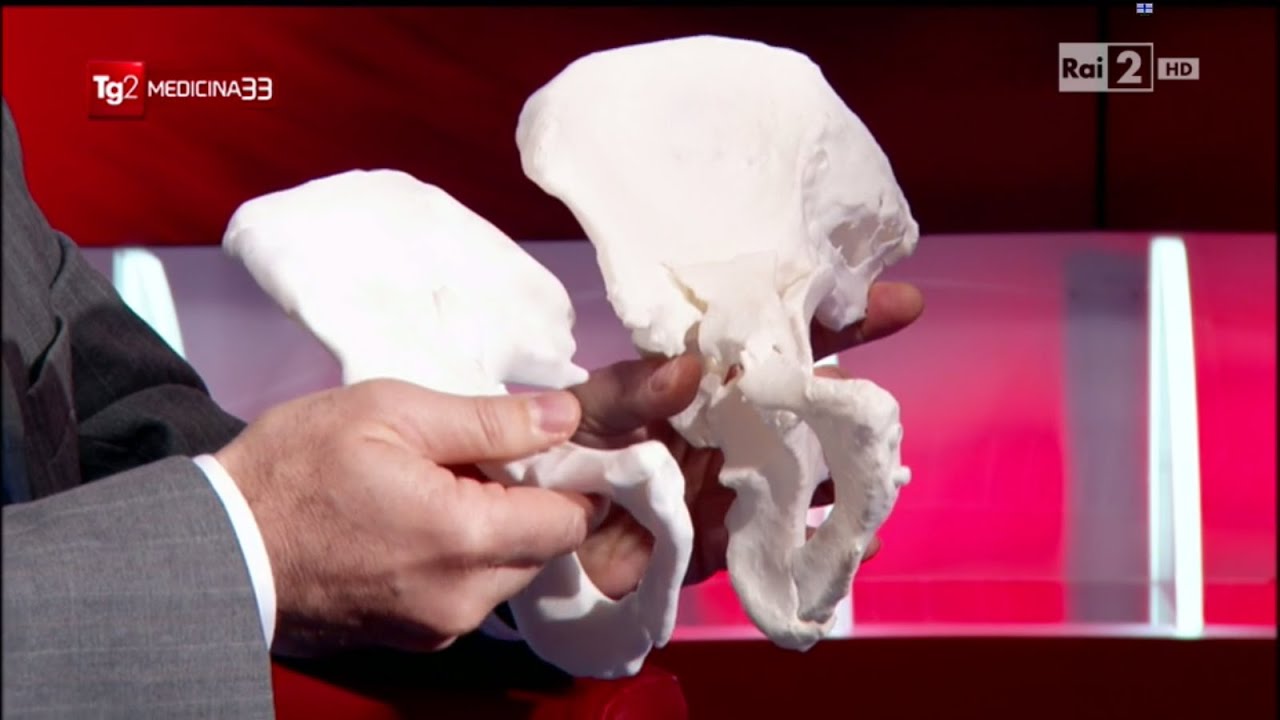 Stampa 3D e frattura del bacino | Tg2 Medicina 33
