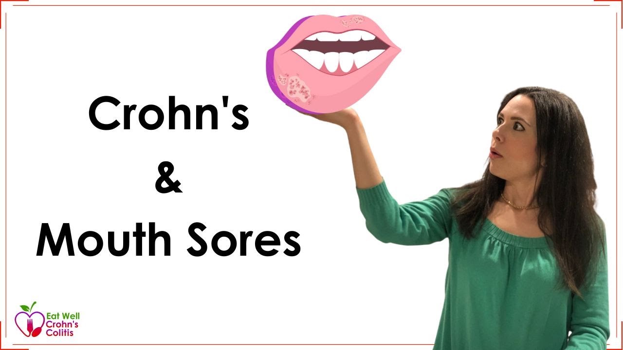Crohn's Disease Mouth Sores: Causes and Treatment