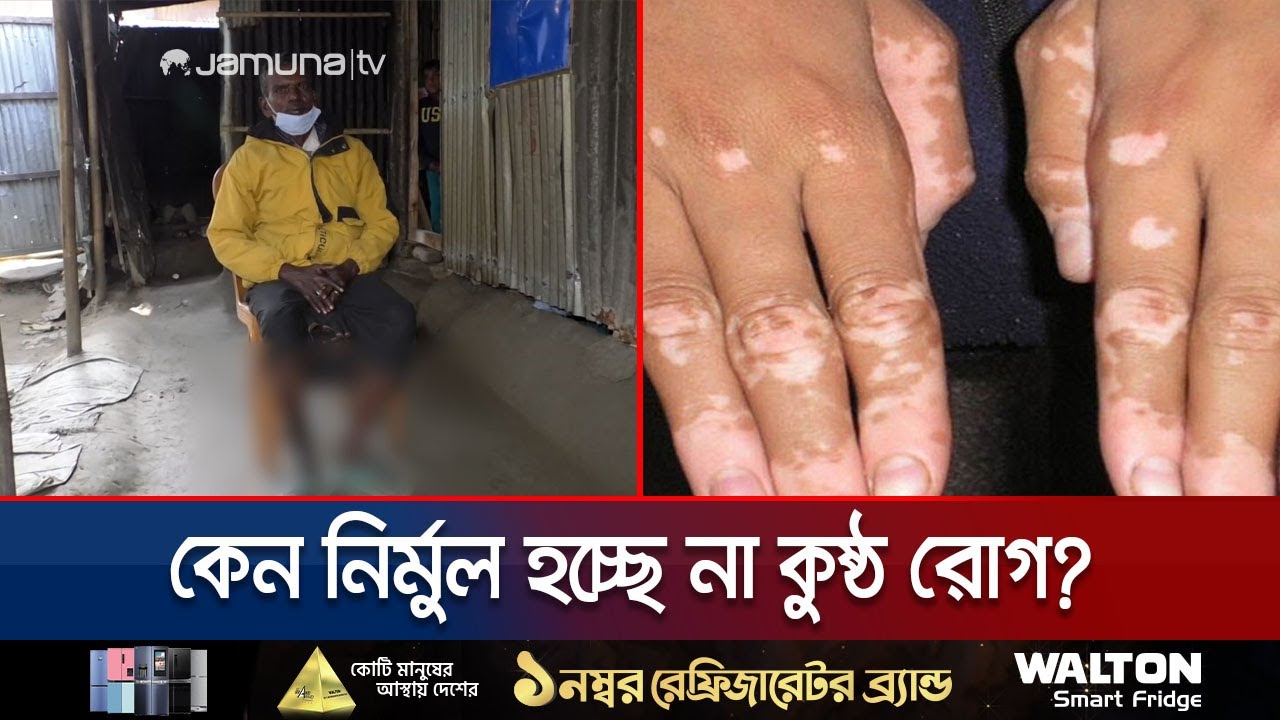 প্রকৃত সরকারি তথ্য নেই কুষ্ঠ রোগীদের; শিকার হচ্ছেন অবহেলার | World Leprosy Day | Jamuna TV