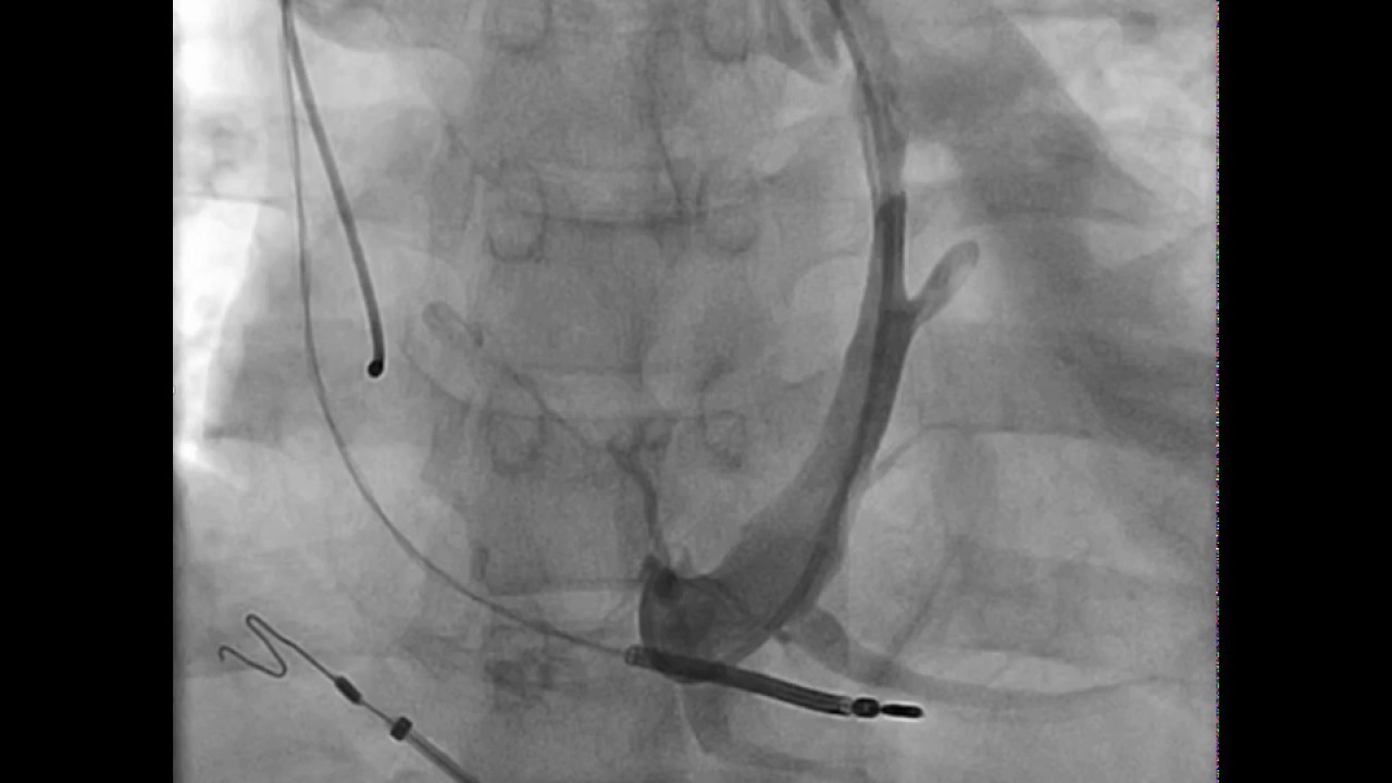 LV lead implantation via persistent vein of Marshall in CS atresia
