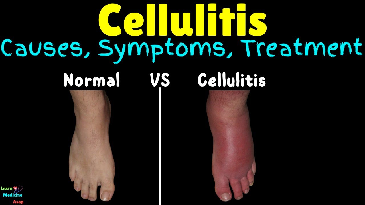 Cellulitis: Symptoms, Causes, Treatment & Prevention