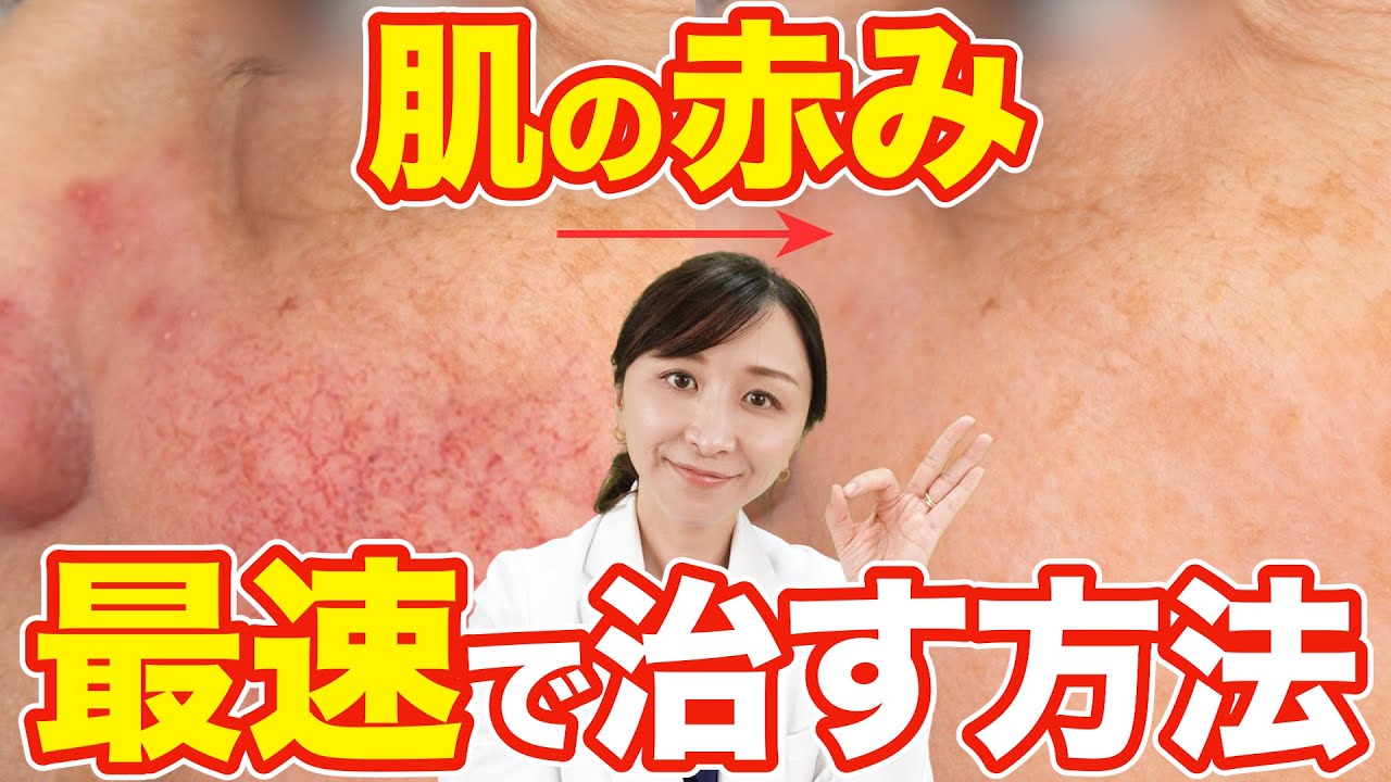 【これやって】肌の赤みを最速で治すための５つのこと