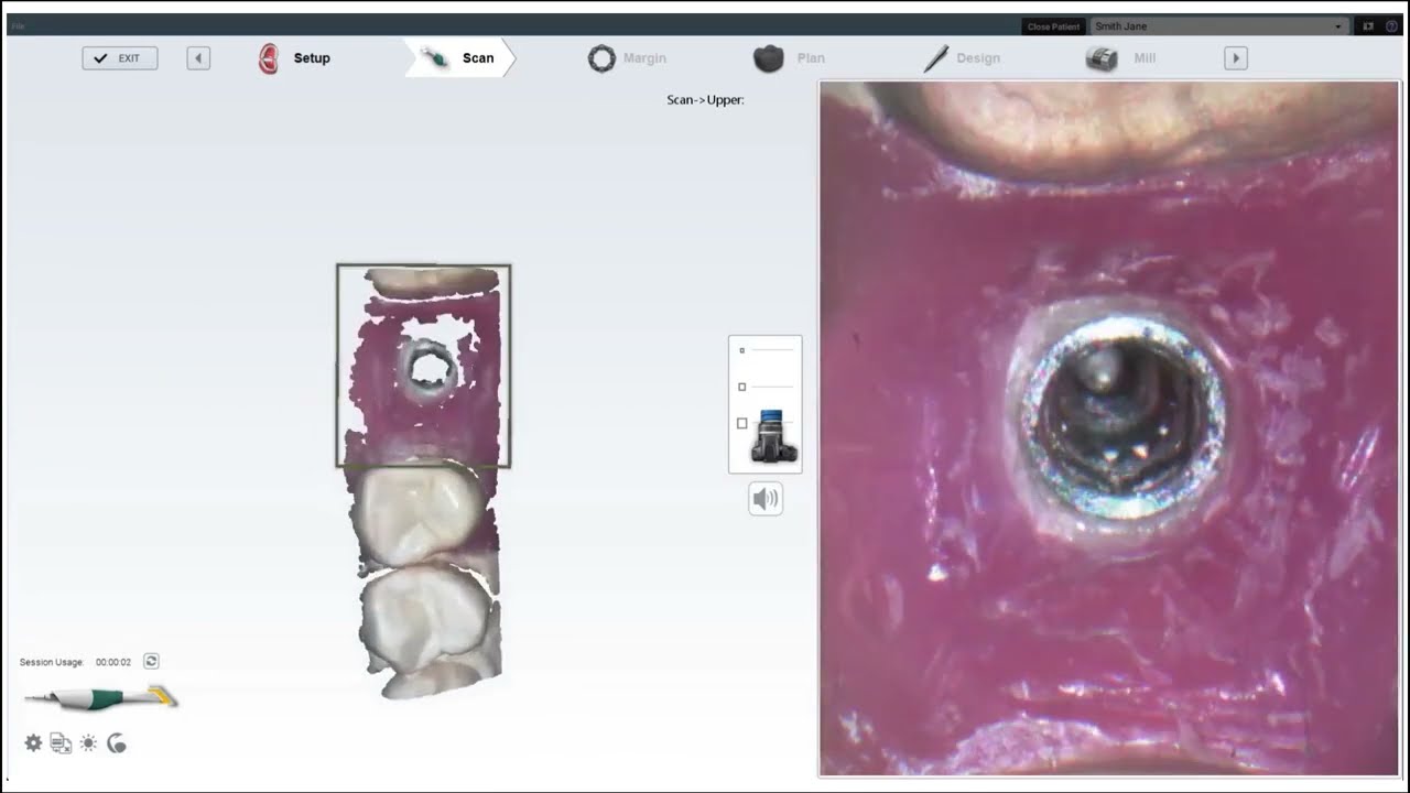 Сканирование scan body в Planmeca Romexis PlanCAD Easy