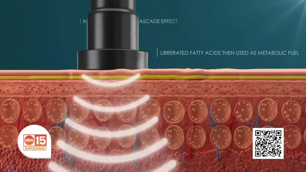 Redefine your shape and renew your confidence with Cellsound body contouring at Nuvell Clinics