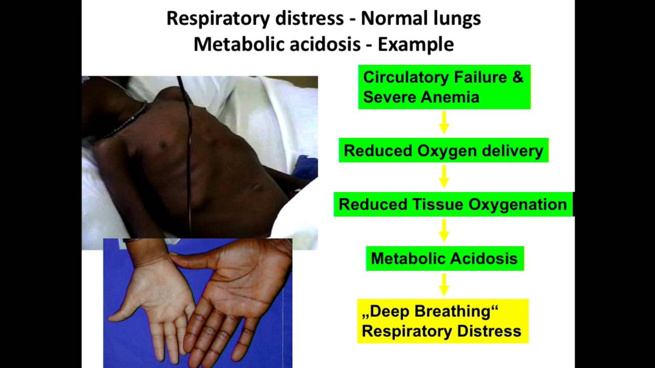 Dr. HJ Lang - Transfer of “critical care strategies” used in high resource settings to RLS
