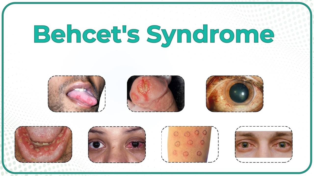 Beh&ccedil;et&rsquo;s Syndrome/Behcet Disease : Causes, Pathology, Clinical presentation Diagnosis and Treatment