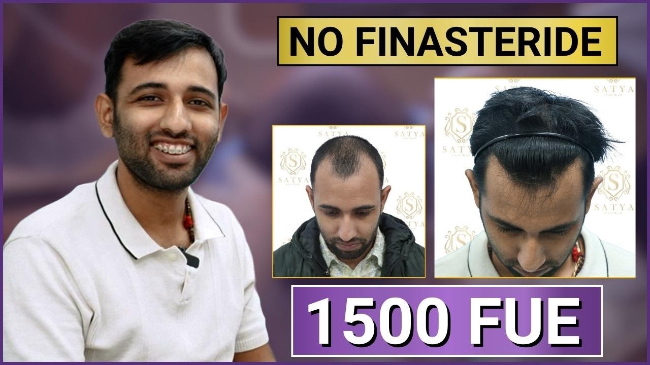 Пересадка волос 1500 графтов | 1500 графтов FUE | Результаты пересадки волос FUE