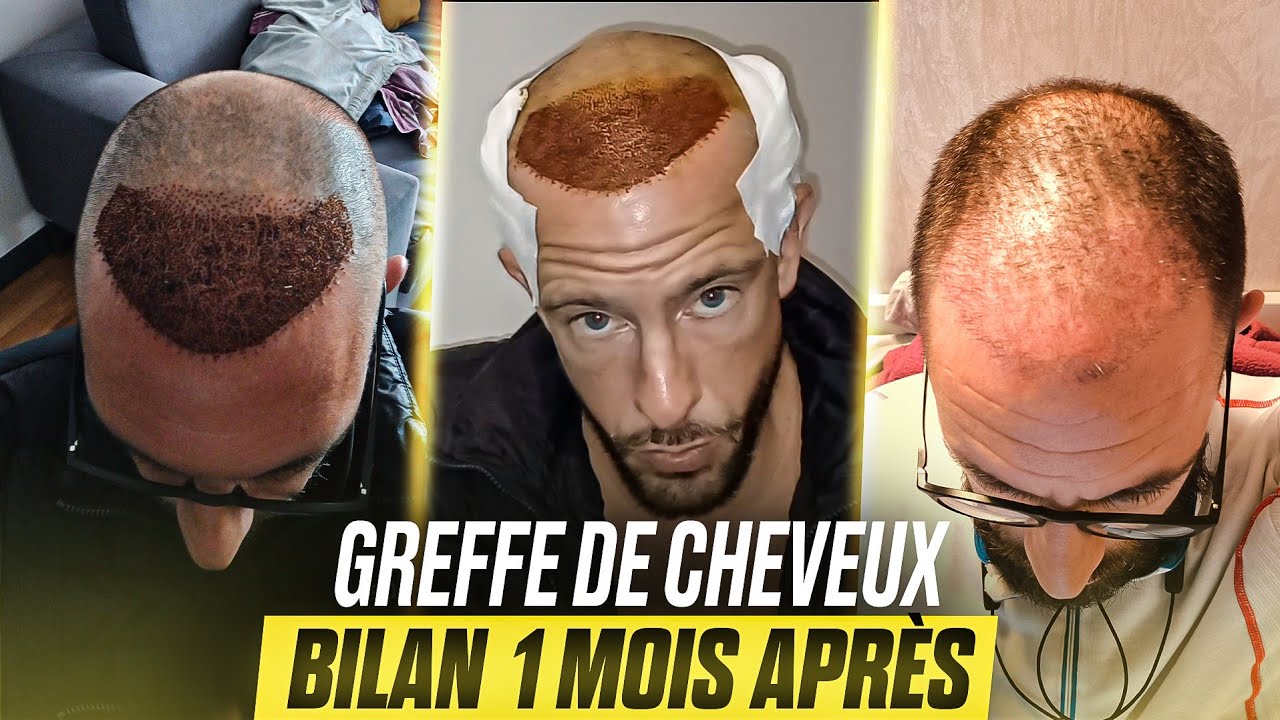 🟢J+30 Greffe de Cheveux | 1 Mois APRÈS mes Implants capillaire en Turquie🇹🇷 avec la Clinique Klineva