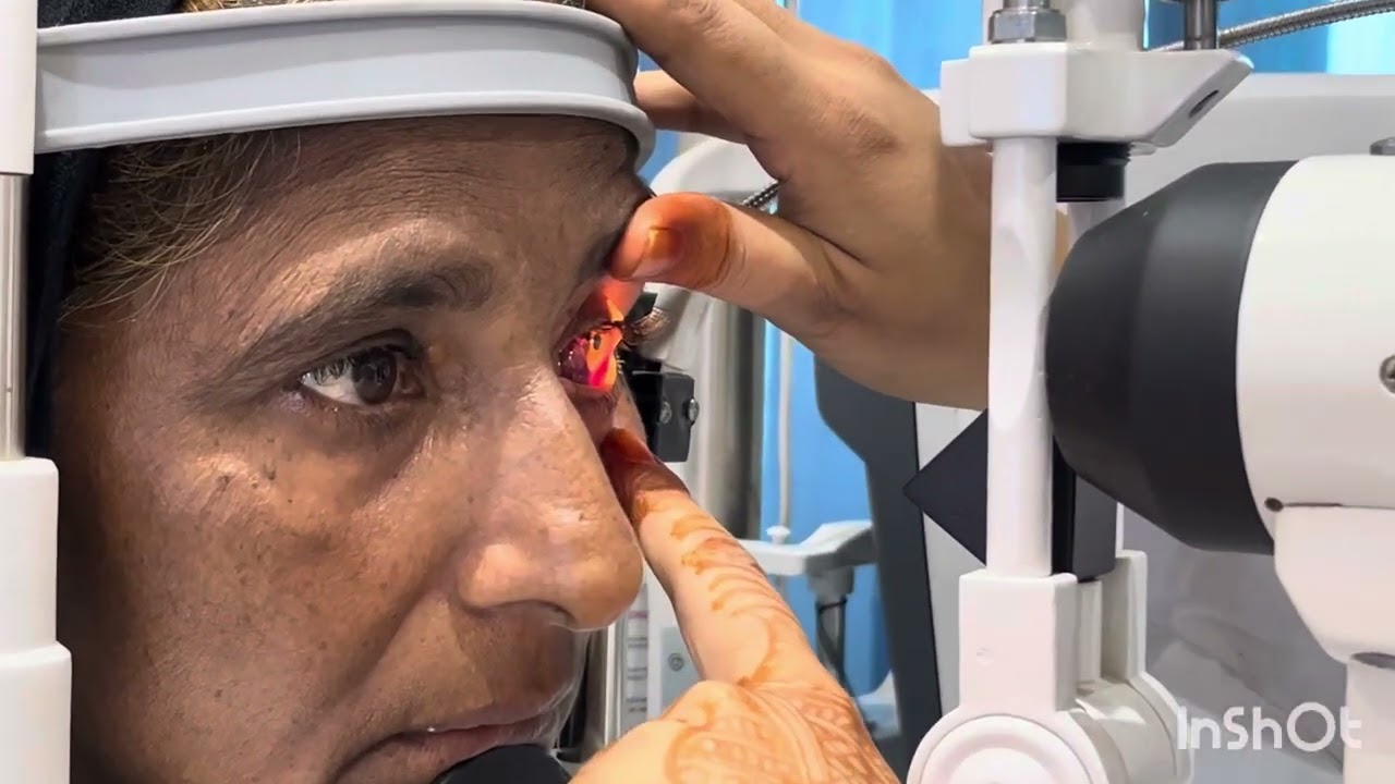 Subconjunctival haemorrhage || live patient video || Treatment | Optometry Solutions 