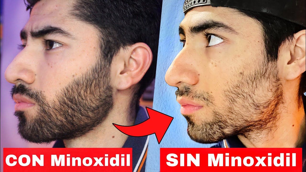 La VERDAD sobre DEJAR el Minoxidil