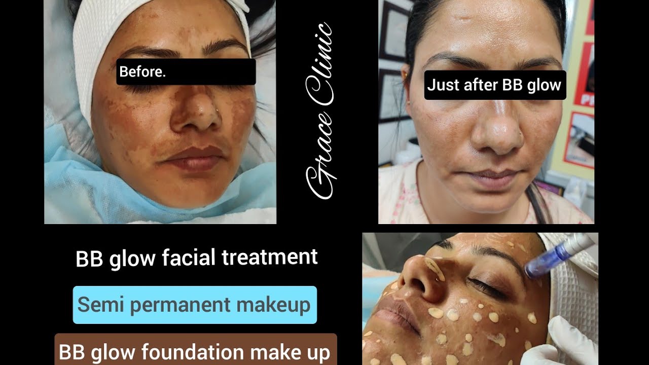 BB glow facial treatment Dehradun| semi-permanent makeup grace clinic | Semi permanent foundation BB