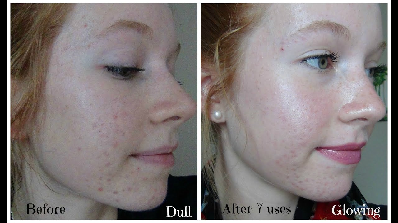 Personal Microderm Review! PMD Demo and Before & After Pictures!